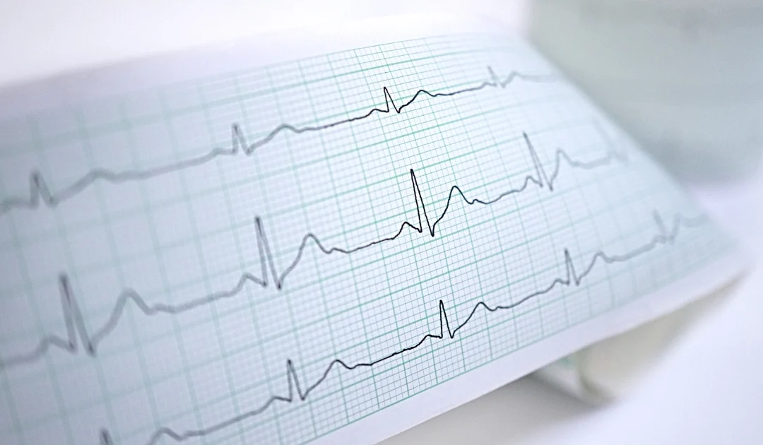 Jak Interpretować Wyniki EKG: Praktyczne Wskazówki